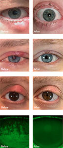 dry-eye-before-after